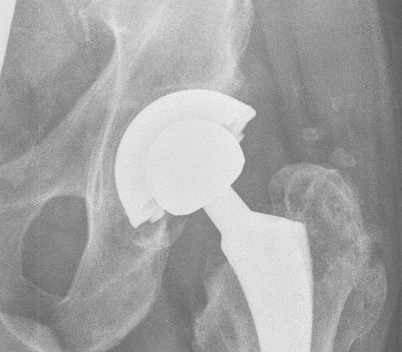 Acetabular Underseating